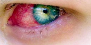 stye on eye, eye pain, viral conjunctivitis, stye treatment, watery eyes, itchy eyes, what is pink eye, how to get rid of pink eye, treatment for pink eye