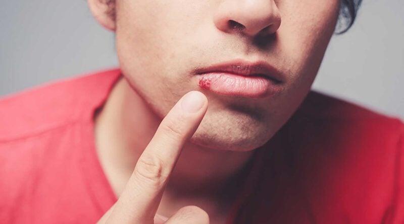 how to hide a cold sore for guys and girls