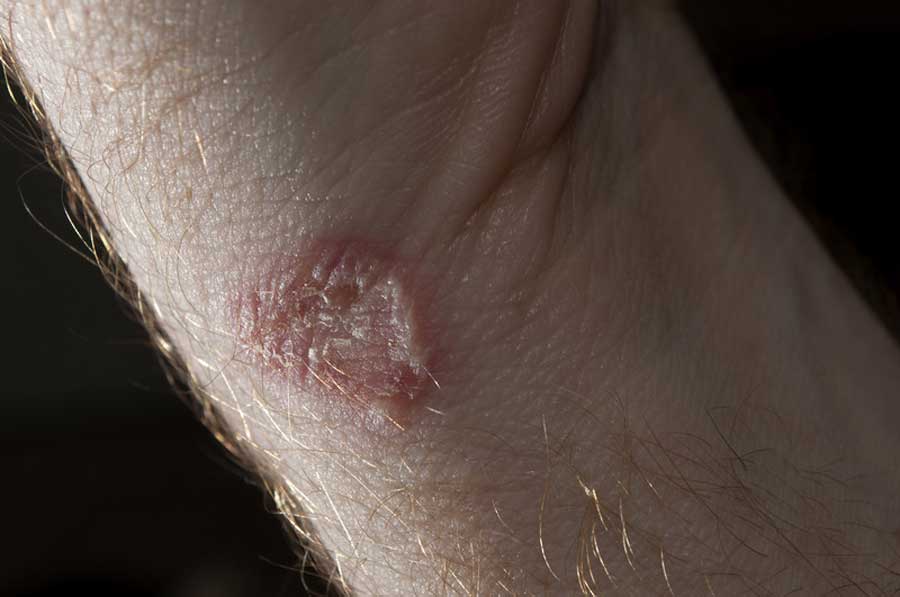 Ringworm: Symptoms, Causes, Treatment, Pictures - I Need Medic